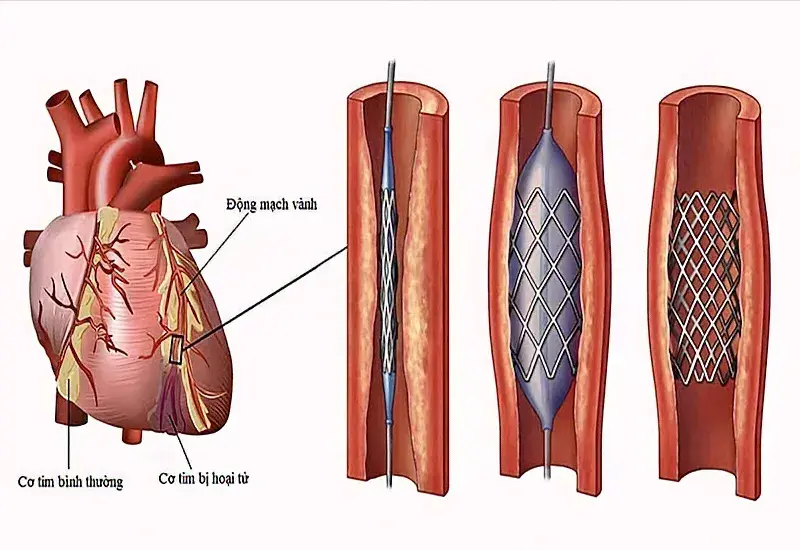 Can thiệp động mạch vành qua da điều trị hội chứng động mạch vành mạn