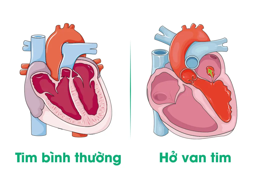 hinh-minh-hoa-ho-van-tim-va-tim-binh-thuong