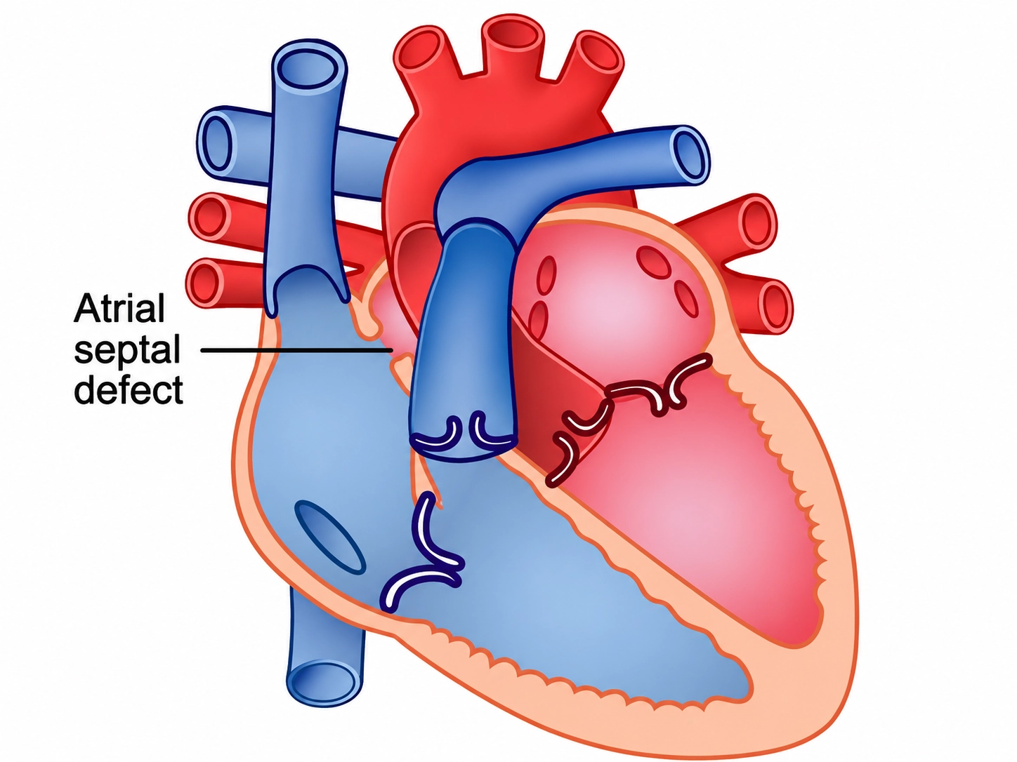 Thông liên nhĩ là một dị tật bẩm sinh của tim