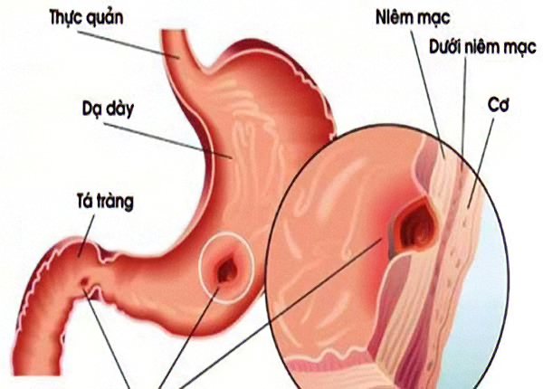 xuất huyết tiêu hoá trên là gì