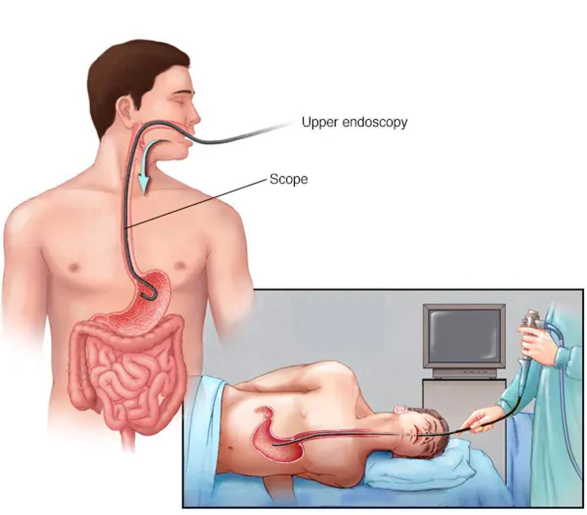 Nội soi dạ dày tá tràng ống mềm