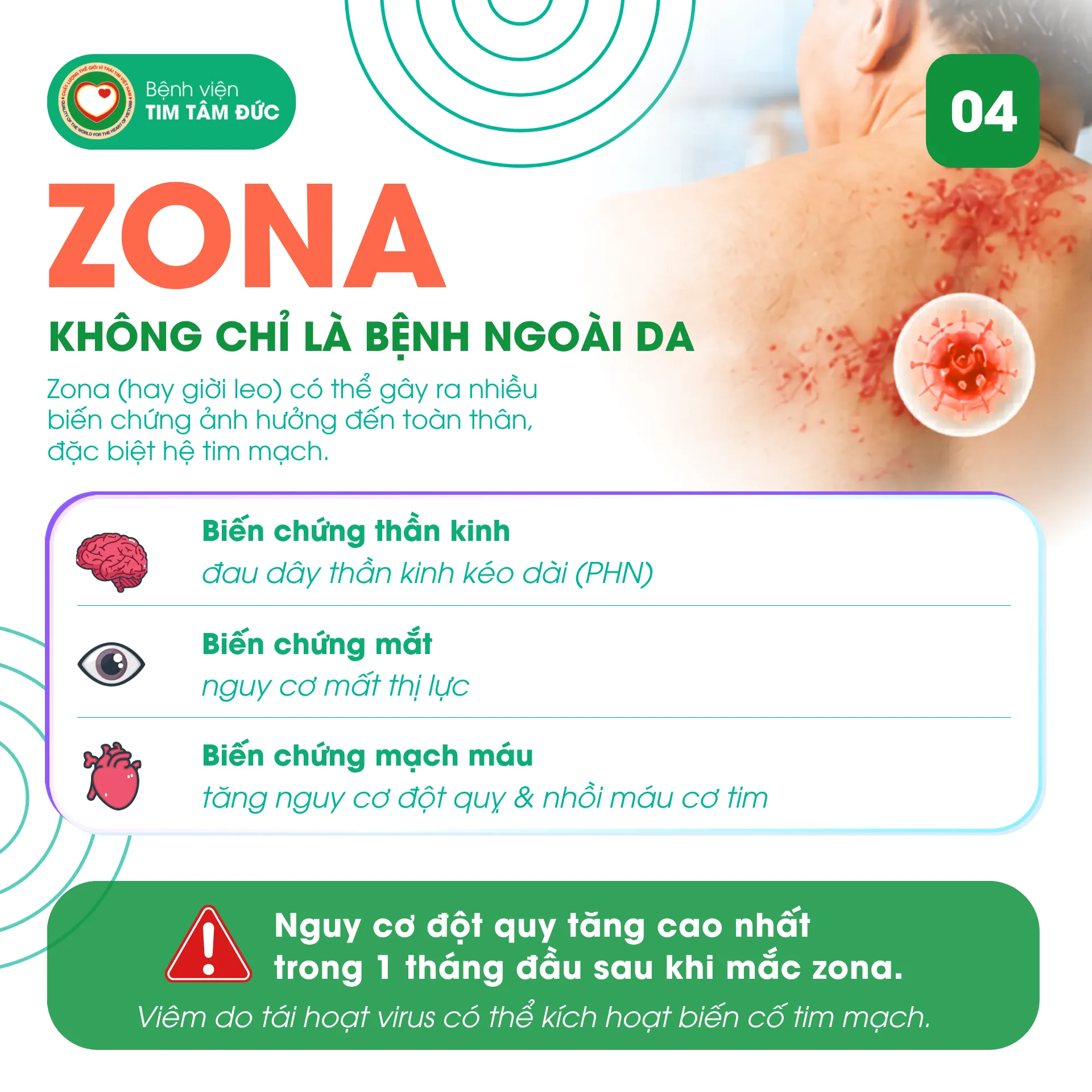 Zona – Không chỉ là bệnh ngoài da