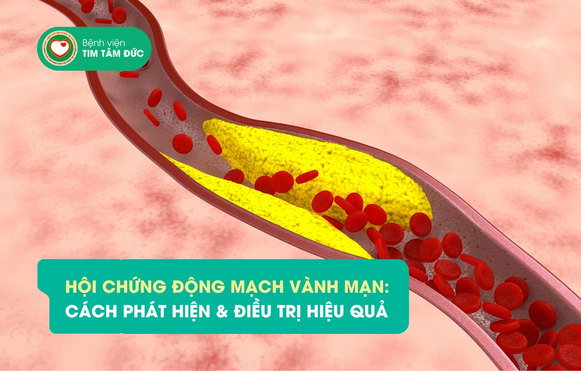 Hội chứng động mạch vành mạn là gì và ai có nguy cơ mắc bệnh?