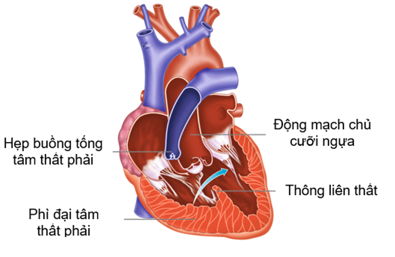 Tứ Chứng FALLOT là một loại bệnh tim mạch khá phổ biến. Xem hình ảnh điện tim để hiểu rõ hơn về bệnh lý này và tìm thấy giải pháp điều trị phù hợp với cơ thể của bạn.