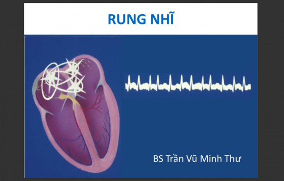 ECG rung nhĩ 2018