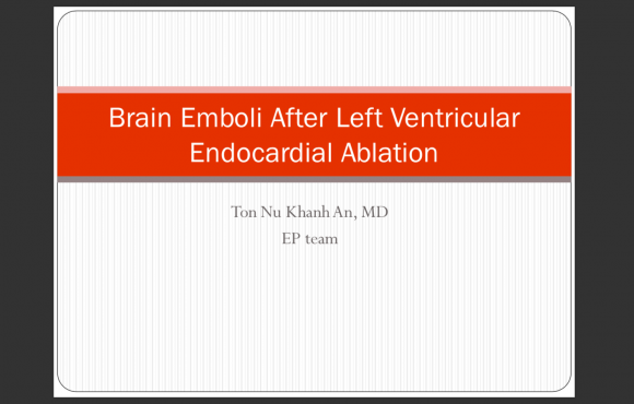 Brain Emboli After Left Ventricular Endocardial Ablation