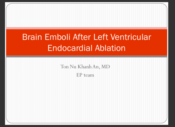 Brain Emboli After Left Ventricular Endocardial Ablation