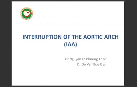 Interrupted Aortic Arch