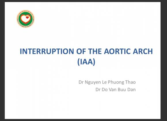 Interrupted Aortic Arch