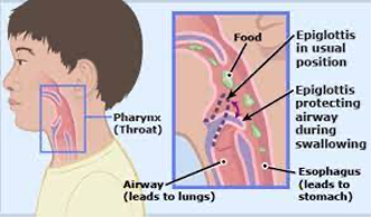 Những biểu hiện và cách xử lý dị vật đường thở ở người lớn 