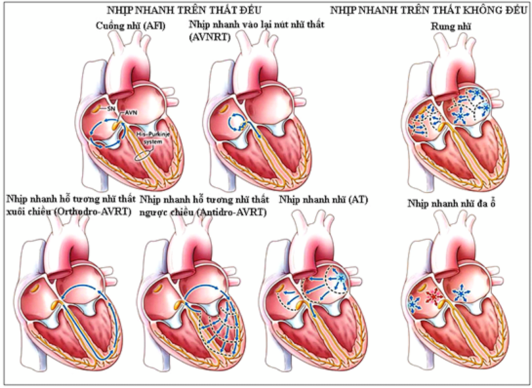 Bạn Bị Rối Loạn Tim Nhanh?