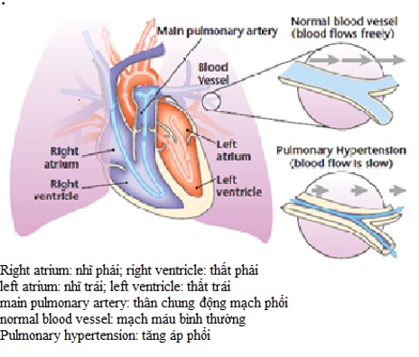 Dấu hiệu của tăng áp lực động mạch phổi là gì?
