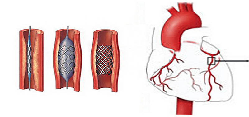 Hình ảnh can thiệp stent động mạch vành