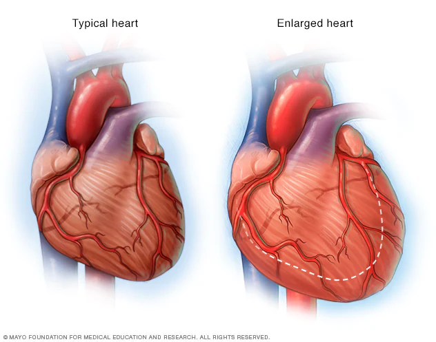 Enlarged heart, in heart failure