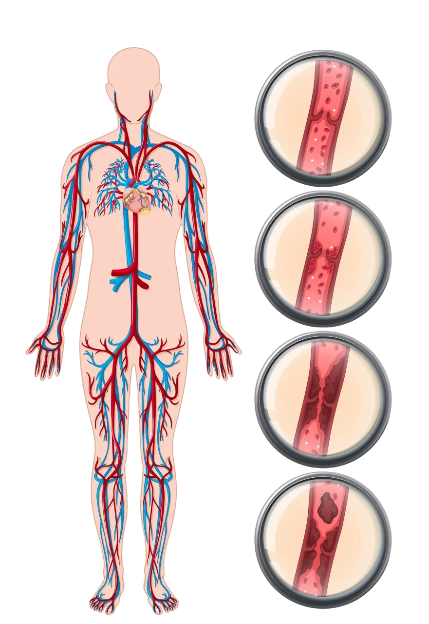 huyết khối - Thrombosis