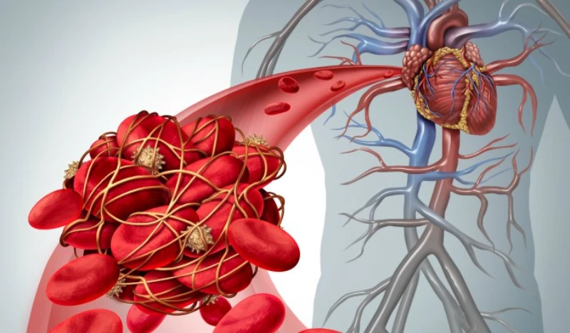 huyết khối - Thrombosis