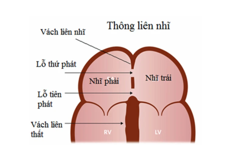 thông liên nhĩ