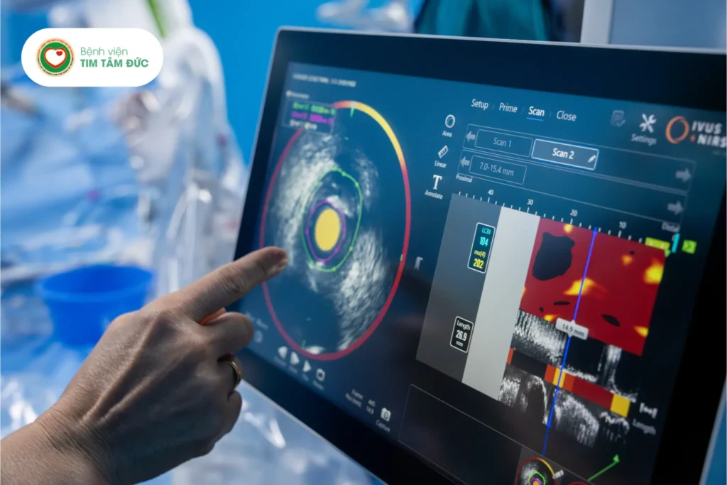 IVUS - NIRS giúp phát hiện sớm mảng xơ vữa nguy hiểm