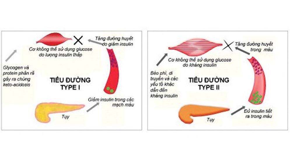 bệnh tiểu đường